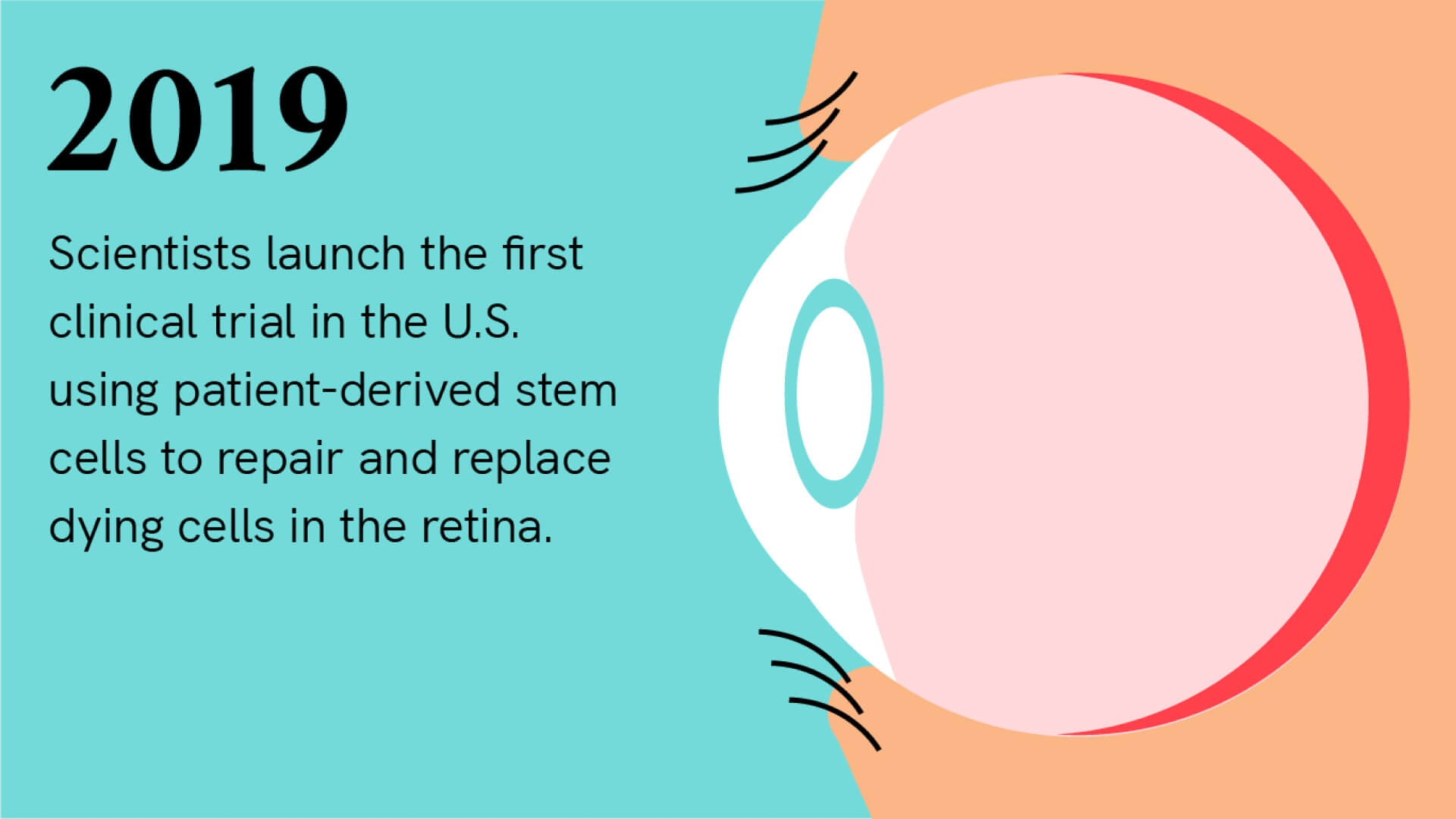 2019: Scientists launch the first clinical trial in the U.S. using patient-derived stem cells to repair and replace dying cells in the retina. Illustration of the side of a human eye in its socket, with the retina at the back of the eye in red.