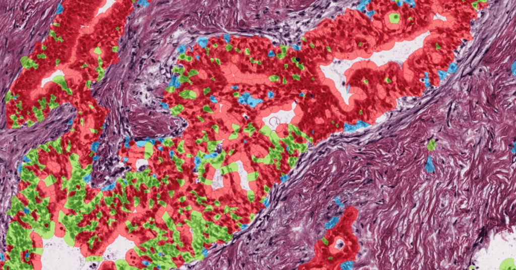 Histology image of a glandular tumor with malignant cell states in red and green against magenta stroma.