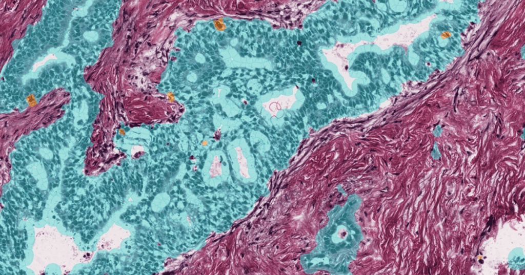 Tumor tissue color-coded by MAPK activity, showing mostly MAPK-low cells in teal with scattered MAPK-high cells in orange.