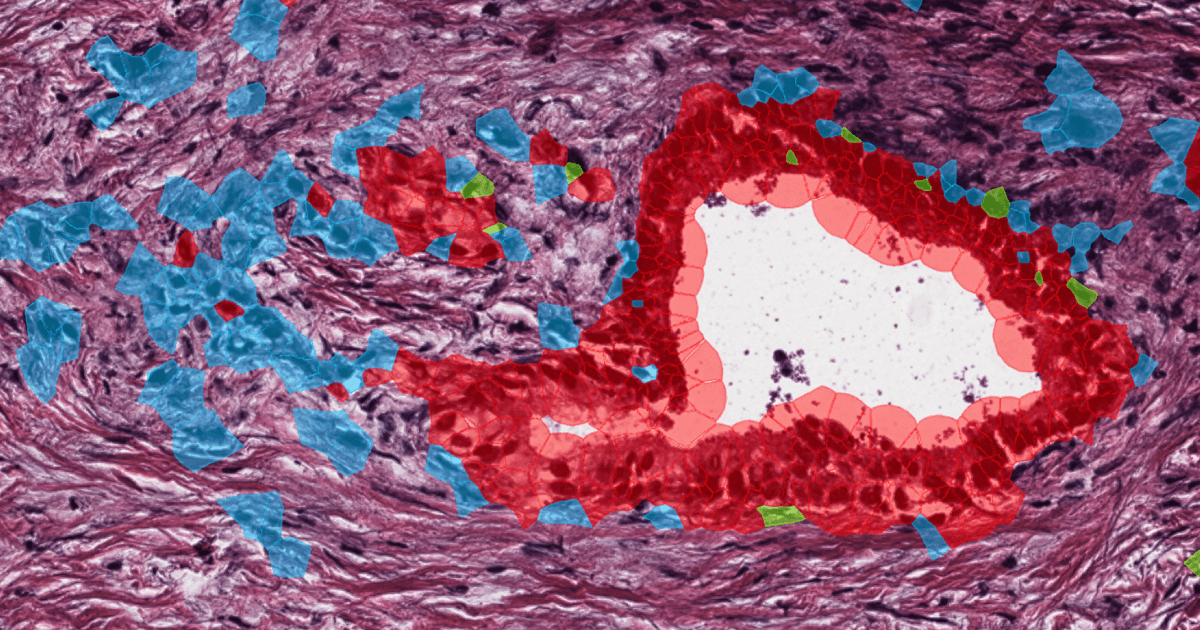 Spatial transcriptomics image of a pancreatic tumor with malignant cell states shown in red, blue, and green.