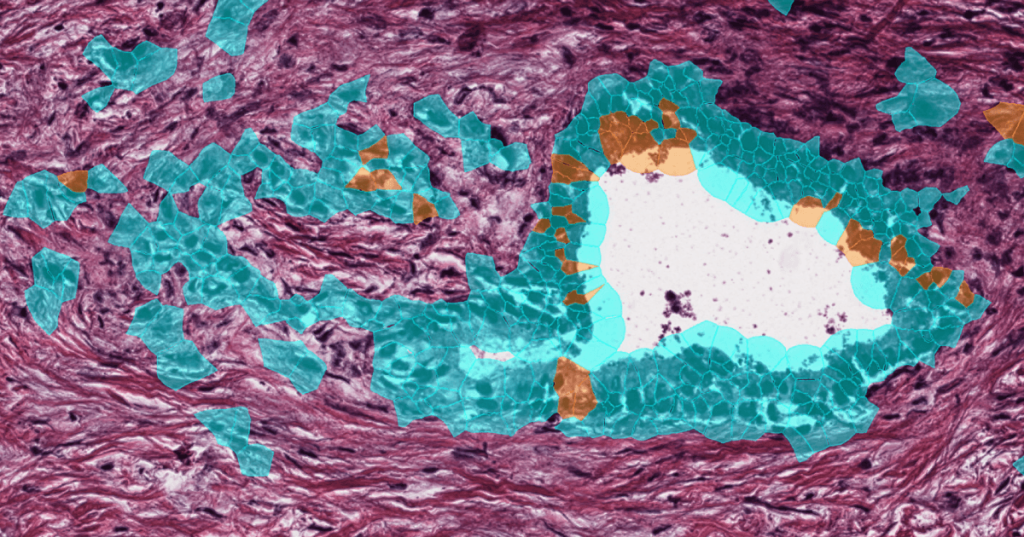 Same tumor gland as Panel C, recolored by MAPK activity, with MAPK-high cells in orange near the gland edge.