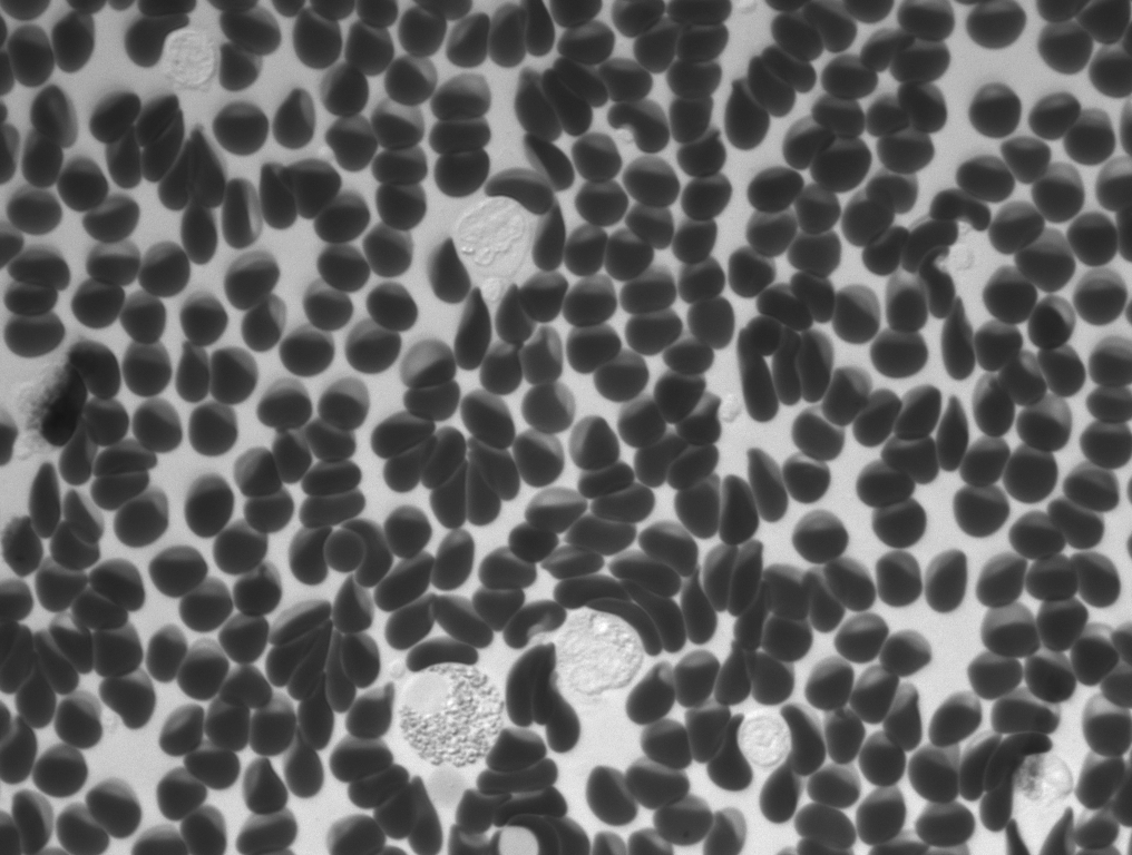 Remoscope image showing dark red blood cells and bright white blood cells with visible internal structures, varied shapes, sizes, and textures.